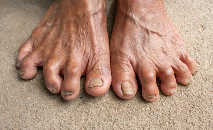 Natürlich haben nicht alle alten Menschen zwangsläufig gelbe Fußnägel. Doch je älter ein Mensch wird, desto weniger stark ist sein Immunsystem. ( Foto: Adobe Stock - Nanthicha Khamphumee )