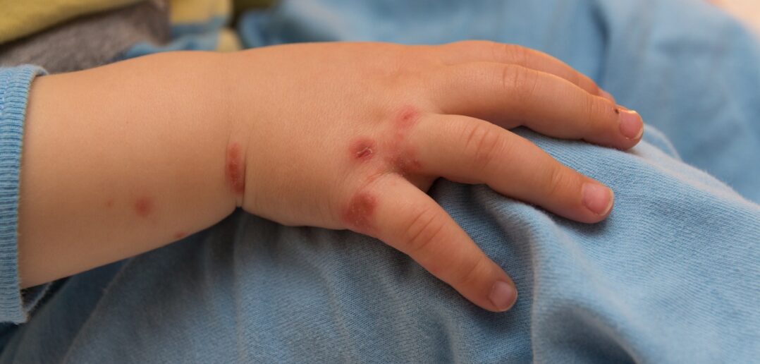 Entzündete Wunden bei Kindern: Was tun bei verschiedenen Wundarten? (Foto: AdobeStock - OFC Pictures -113696157)