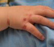 Entzündete Wunden bei Kindern: Was tun bei verschiedenen Wundarten? (Foto: AdobeStock - OFC Pictures -113696157)