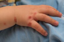 Entzündete Wunden bei Kindern: Was tun bei verschiedenen Wundarten? (Foto: AdobeStock - OFC Pictures -113696157)