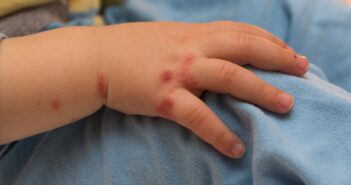 Entzündete Wunden bei Kindern: Was tun bei verschiedenen Wundarten? (Foto: AdobeStock - OFC Pictures -113696157)